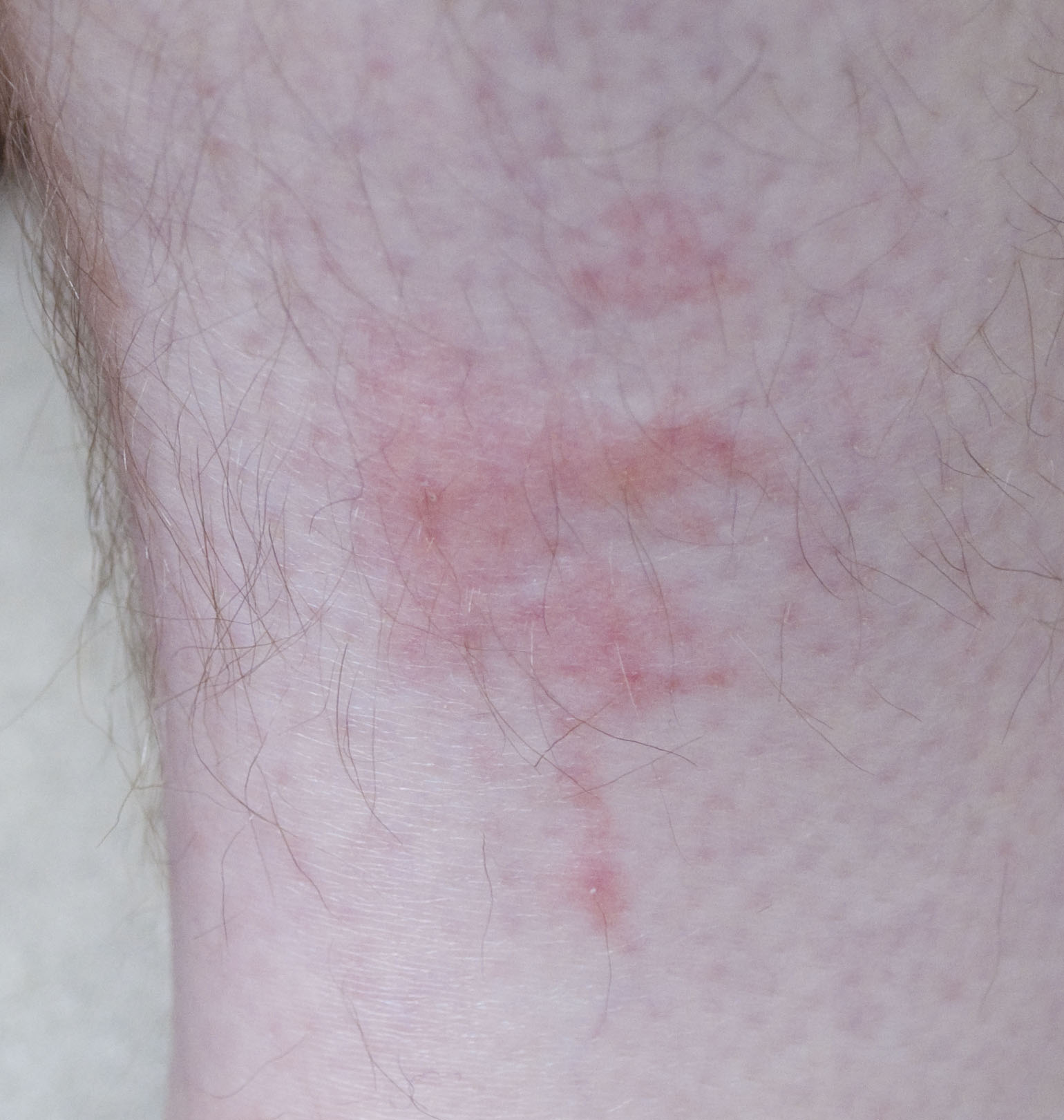 Bed bug bites in a row on a person's skin