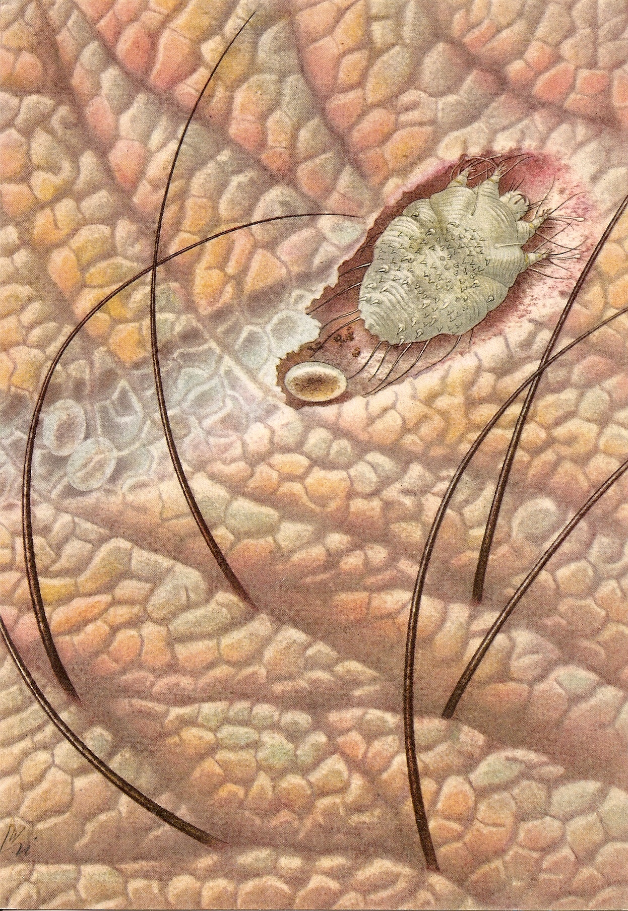 Scabies mite Sarcoptes scabiei under magnification